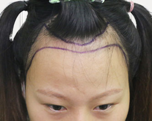 在杭州華山連天美治療我的發(fā)際線后移術(shù)后恢復(fù)效果分享